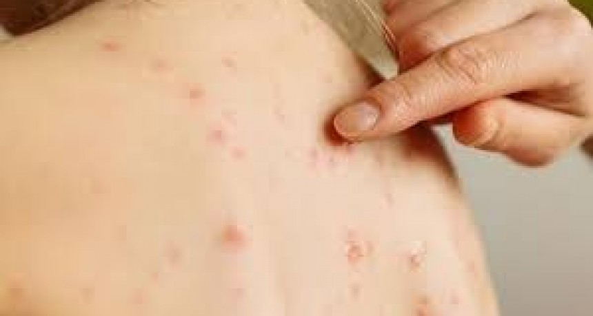 Hay 300 personas bajo seguimiento por sarampión tras la confirmación de 13 casos en el AMBA