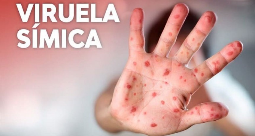 Viruela símica: la Provincia confirma que hay dos casos y advierte por nueva variante